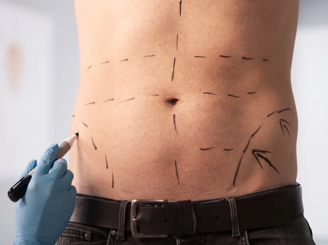 Marcação cirúrgica no planejamento da lipoaspiração masculina