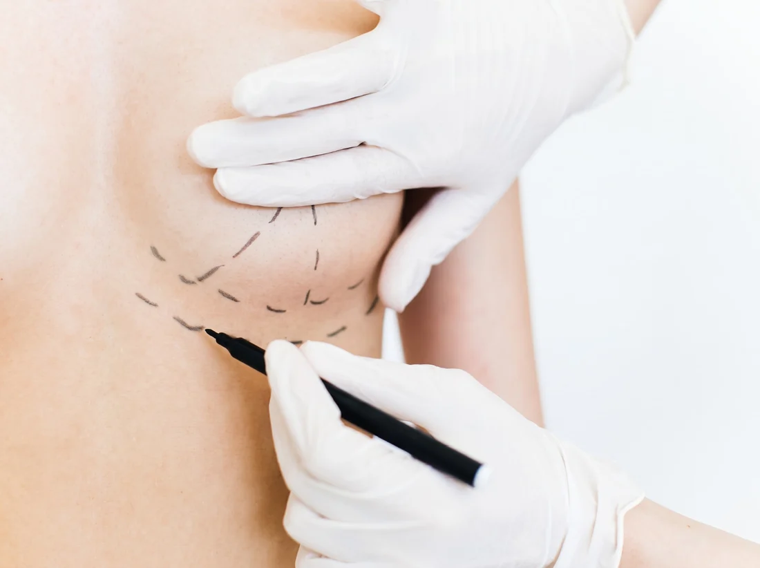 Cirurgião realizando marcações com caneta na mama durante o planejamento da mastopexia